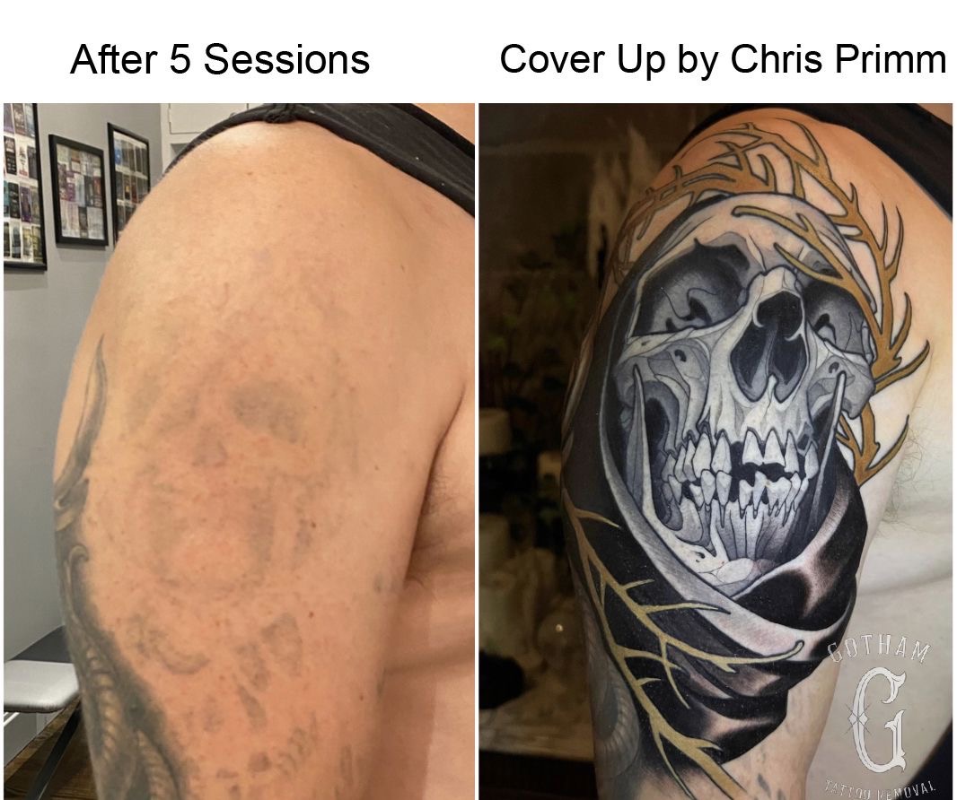 Gotham Tattoo Removal Image 3